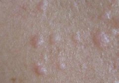 马齿苋能治扁平疣吗,马齿苋可以治扁平疣吗,马齿苋能不能治扁平疣