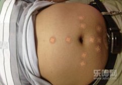 埋线减肥有效吗,埋线减肥效果怎么样