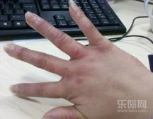 冻疮手指变粗怎么办,生冻疮后手指变粗怎么办,冻疮手指怎么变细