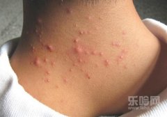 毛囊炎可以用红霉素软膏吗,毛囊炎用红霉素软膏可以吗