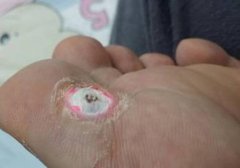 鸡眼贴到什么程度才算好,鸡眼贴要贴到什么程度,鸡眼贴要贴多久