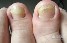 脚趾甲空了是什么原因,脚趾甲变空是怎么回事,为什么脚趾甲会空掉