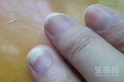 灰指甲擦什么药好,什么药治灰指甲最好,治灰指甲的外用药