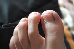 灰指甲什么人出现多,哪些人容易得灰指甲,什么人容易得灰指甲