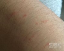 被蚊子咬了起红点怎么回事,蚊子咬了为什么是红点,被蚊子咬了起红