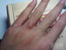 手上起小水泡痒怎么办,手上起小水泡痒如何处理,手上起小水泡痒怎