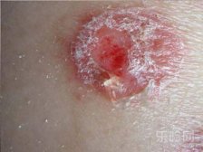 银屑病的症状和特点,银屑病的症状,银屑病有什么症状