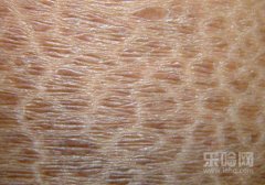 鱼鳞病与银屑病的区别,鱼鳞病是银屑病吗,鱼鳞病和银屑病的区别