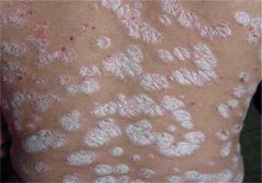 银屑病会传染给别人吗,银屑病能传染吗,银屑病是传染病吗