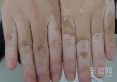 白斑风有什么症状