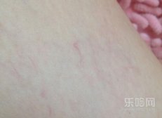 腿上有红血丝是怎么回事,腿上有红血丝是什么原因