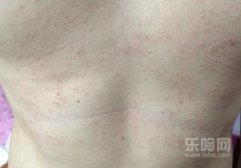 背上长痱子一样的红疹怎么办,夏天后背长小颗粒状红疹怎么办
