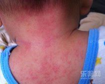 夏天身上长红疙瘩很痒是怎么回事,夏天身上长红包很痒是什么原因