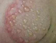 拔罐水泡是什么原因,拔罐起泡是怎么回事