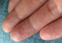 夏天手上起小水泡是怎么回事,一到夏天手上就长水泡是怎么回事,为