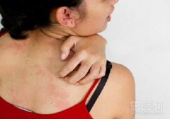 过敏性荨麻疹怎么治疗,过敏性荨麻疹怎么办,过敏性荨麻疹怎么根治