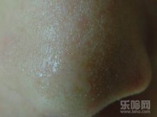 鼻子上挤出来的白色东西是什么,鼻子上挤出的白色东西是什么,鼻子