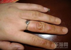 烫伤后怎样恢复得快,烫伤后怎样恢复得快啊,烫伤后怎么处理好的快