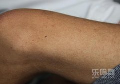 过敏性紫癜严重吗,过敏性紫癜会死人吗,过敏性紫癜严重会怎样