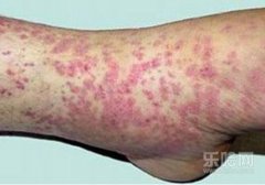 过敏性紫癜能治好吗,过敏性紫癜能根治吗,过敏性紫癜可以治愈吗