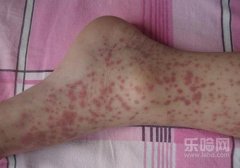 过敏性紫癜的症状,过敏性紫癜有什么症状,过敏性紫癜的临床表现