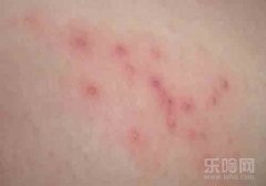 湿疹是怎么引起的,什么是湿疹,湿疹是什么