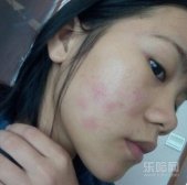 洗面奶过敏有什么症状,如何避免洗面奶过敏