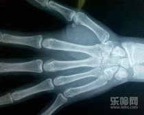 骨龄提前一定长不高吗,骨龄提前会影响身高吗