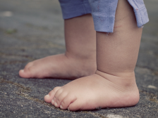 脚后跟干裂是什么原因 8方法让你远离烦恼